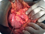 Surgery CA Pancreas